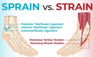 Sprain v Strain